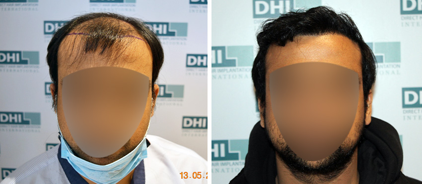 DHI before & after hair transplant results